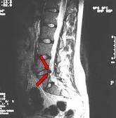 Tratamiento no quirurgico de la Hernia Discal