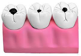 Descubre el significado de soñar con caries. sueño con una carie