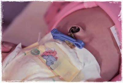 Cuidados del cordón umbilical en el recién nacido