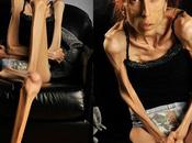 Actriz pide ayuda Internet para salvar vida anorexia