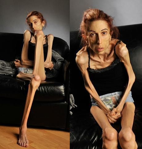 Actriz pide ayuda en Internet para salvar su vida de la anorexia 052015-cc-Rachel3