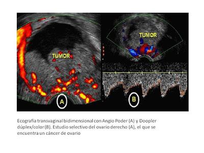 ¿Podemos prevenir el cáncer de ovario?