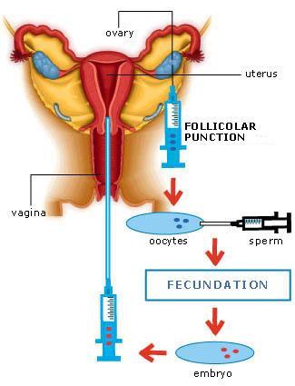 HIPERESTIMULACIÓN OVÁRICA Y FIVET
