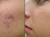 Mejores Mascarillas Caseras para Acné