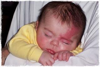 La piel del recién nacido, ¿qué es normal?