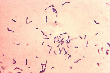 ¿Es el aluminio de las vacunas tóxico? Difteria. Fuente Wikipedia
