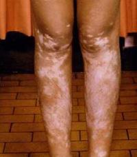 Información sobre consulta de vitiligo en Cuba