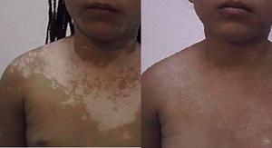 Información sobre consulta de vitiligo en Cuba