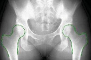 Diseñan software para delinear huesos con rayos X.