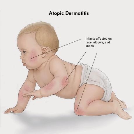 la dermatitis atópica