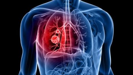 Fármaco experimental reduce un difícil tumor de pulmón