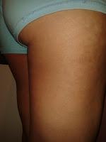 antes y despues anticelulítico