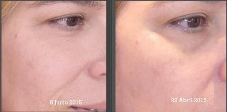 Súper díficil recrear las mismas condiciones de foto. No está quitada pero se ha atenuado, verdad? Experimentando con el nuevo Bio 10 anti-manchas de Bella Aurora