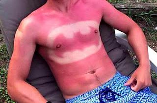 Sunburn Art:   El arte de quemarse al sol