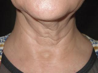 3 Tratamientos caseros para el rejuvenecimiento del cuello