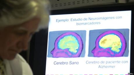 Nuevo tratamiento consigue eliminar placas de alzheimer mediante ultrasonidos