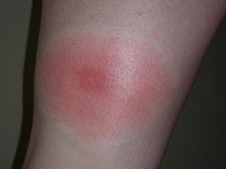 PICADURAS DE MOSQUITO