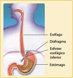 El reflujo gastroesofágico