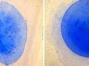 láser preciso para cirugía cataratas