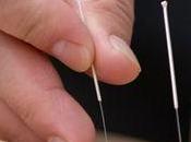 Acupuntura: Incluida patrimonio inmaterial humanidad Unesco