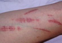 Autolesionarse en la adolescencia vinculado a problemas en salud mental en la adultez 50% de descuento en el curso online: introducción a la conducta suicida y su prevención