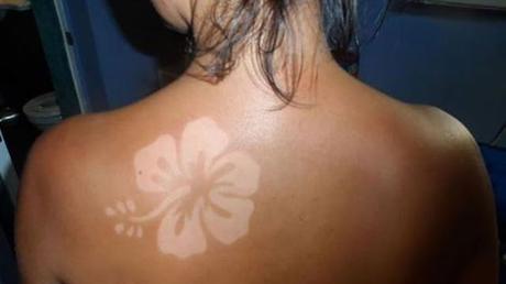sunburn, tatuaje solar