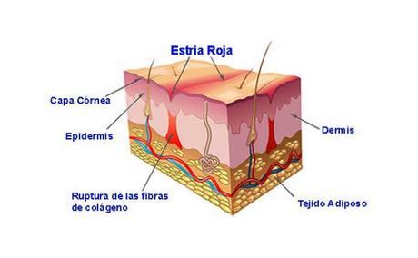 Composicion de la piel con estrias rojas