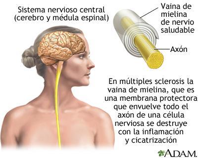 Nuevos ensayos contra la Esclerosis Múltiple