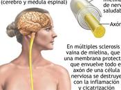 Nuevos ensayos contra Esclerosis Múltiple