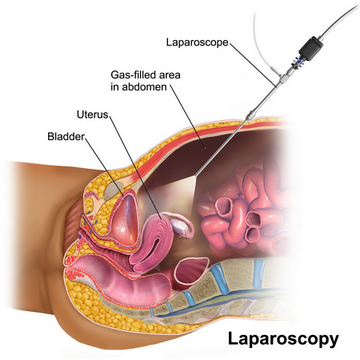 laparoscopia