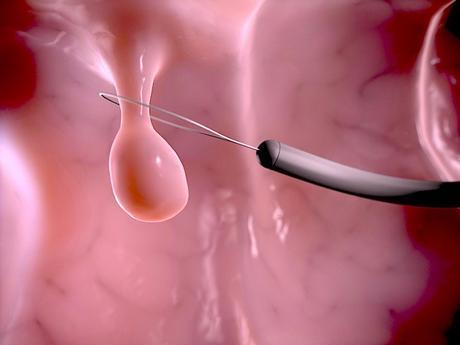 Los pólipos colorrectales