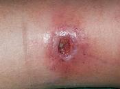 Úlcera varicosa