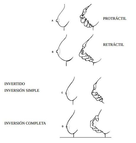 Clasificación del pezón. Riordan y Auerbach, 1998