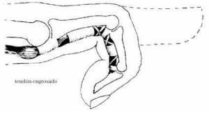 Dedo gatillo, posible complicación de la AR Dedo en gatillo Artricenter 4