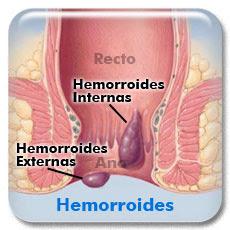 ¿Qué son las hemorroides?