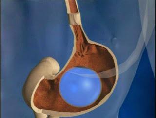 clínicas adelgazar Almería tratamiento con el Balón Intragástrico