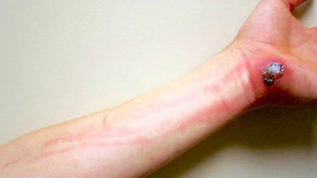 La celulitis, una infección bacteriana de la piel