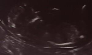 El significado de soñar con una ecografía. sueño con una ecografía