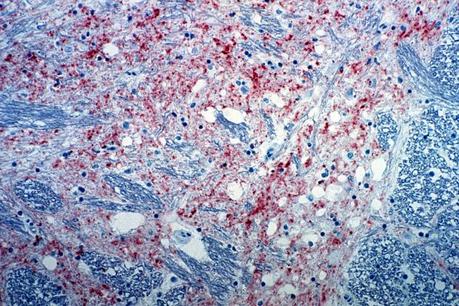 Priones, las proteínas asesinas