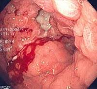 Investigan Vacuna contra el Adenocarcinoma Gastrico