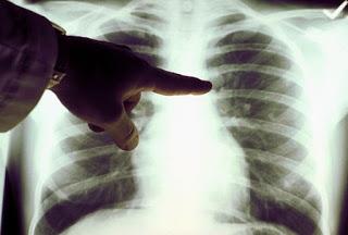 Síntomas de cáncer de Pulmón
