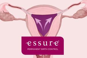 Essure bayer anticonceptivo daños