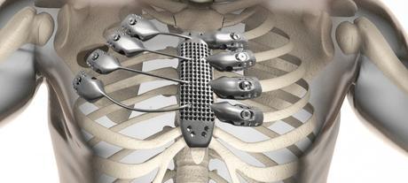 Implantan un esternón de titanio impreso en 3D a un paciente esternon-3d-costillas-titanio-impresion-1000x450