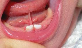 FRENILLO LINGUAL CORTO frenillo2