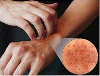 DERMATITIS DE LAS MANOS: CÓMO SOLUCIONAR ESTE PROBLEMA TAN FRECUENTE E INVALIDANTE