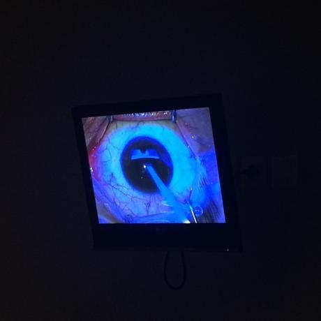 #RelexSmileVlc: EL DÍA DE LA OPERACION DE MIOPIA! #RelexSmileVlc: EL DÍA DE LA OPERACION DE MIOPIA!