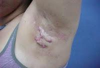 La Hidradenitis Supurativa