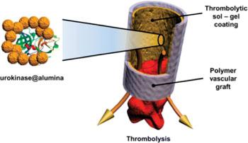 Nuevo revestimiento para injertos vasculares disuelve coagulos sanguineos.