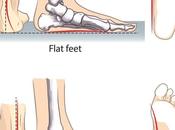 Pronación, amortiguación natural. ¿Aliada enemiga?
