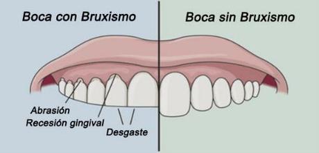 Articulación Temporomandibular y Running